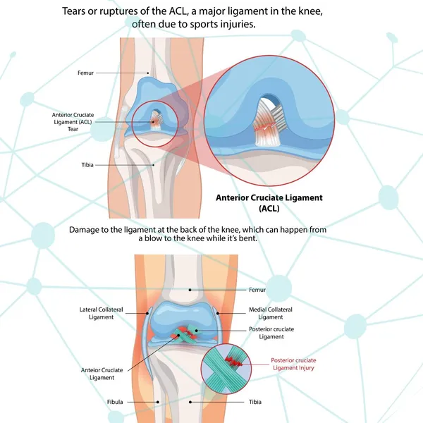 ACL And PCL Tear