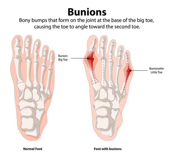 Bunion