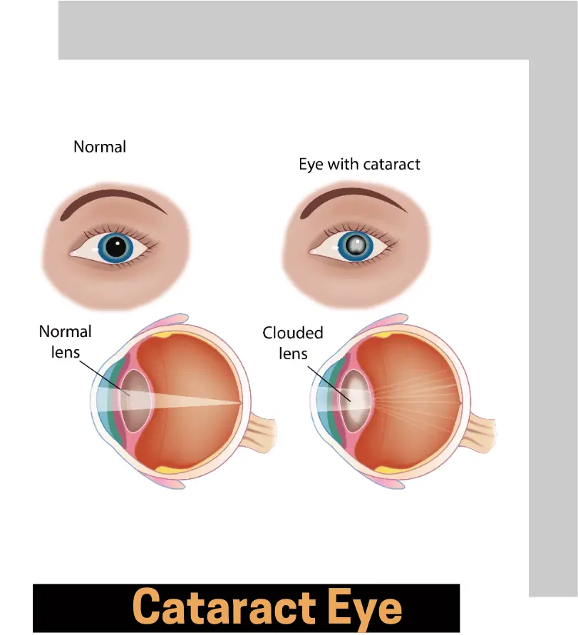 Cataract Eye