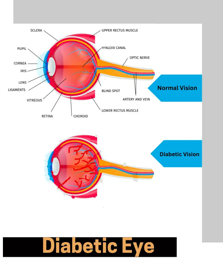 Diabetic eye Care