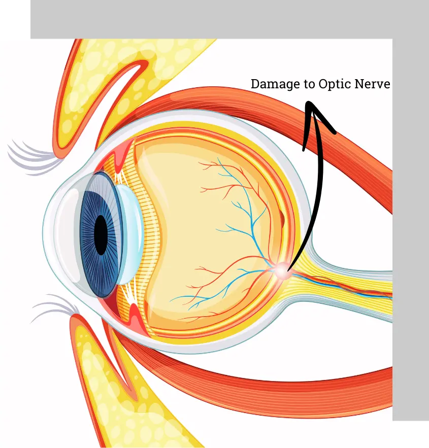 Glaucoma Eye