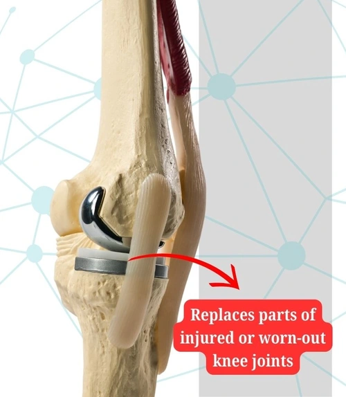 Knee Replacement